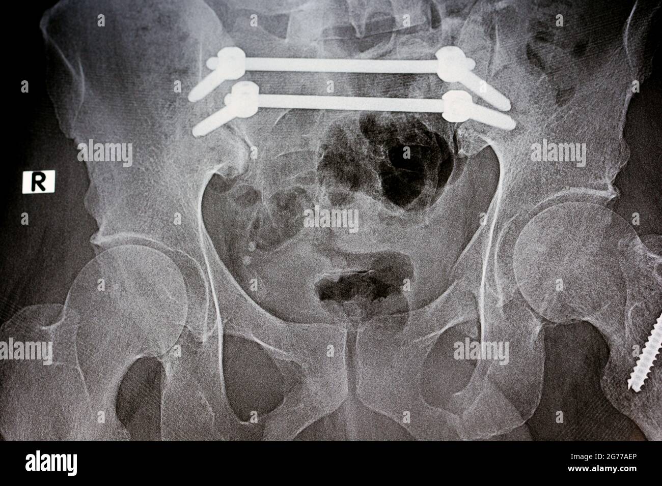 Radiografia piana con una pelvi da frattura fissata con 4 viti e 2 aste e frattura di un grande trocantere del femore fissato con 2 viti Foto Stock