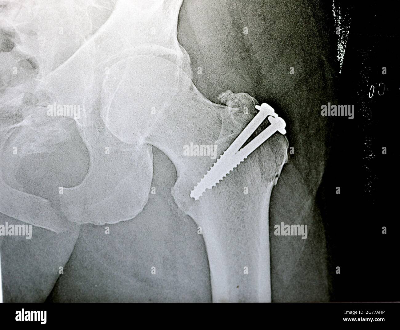 radiografia piana sull'anca sinistra unita a una frattura del grande trocantere del femore fissato con 2 viti in un intervento di riduzione aperta Foto Stock