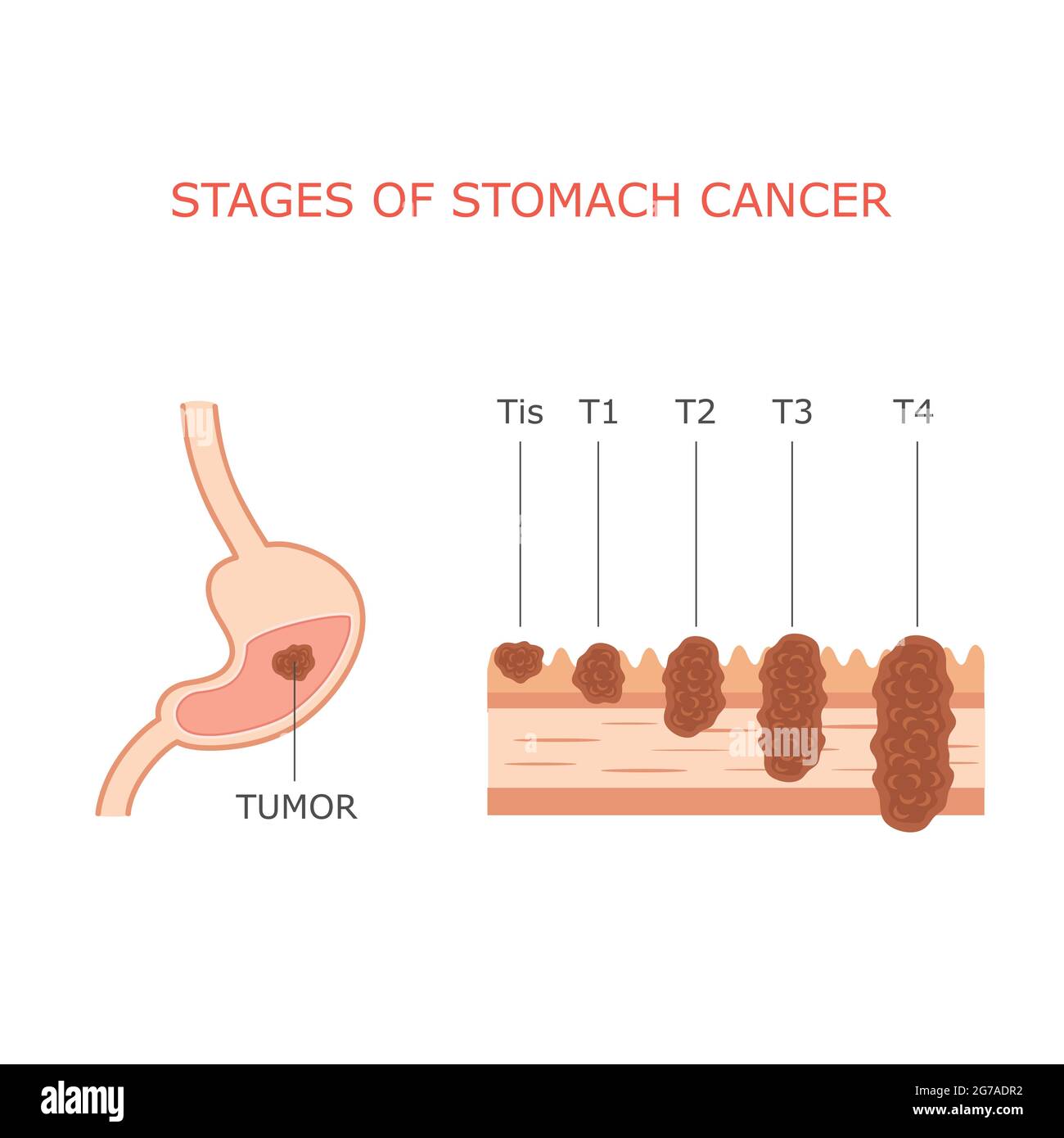stadi di cancro allo stomaco, anatomia del tumore gastrico umano, sistema  digestivo Immagine e Vettoriale - Alamy