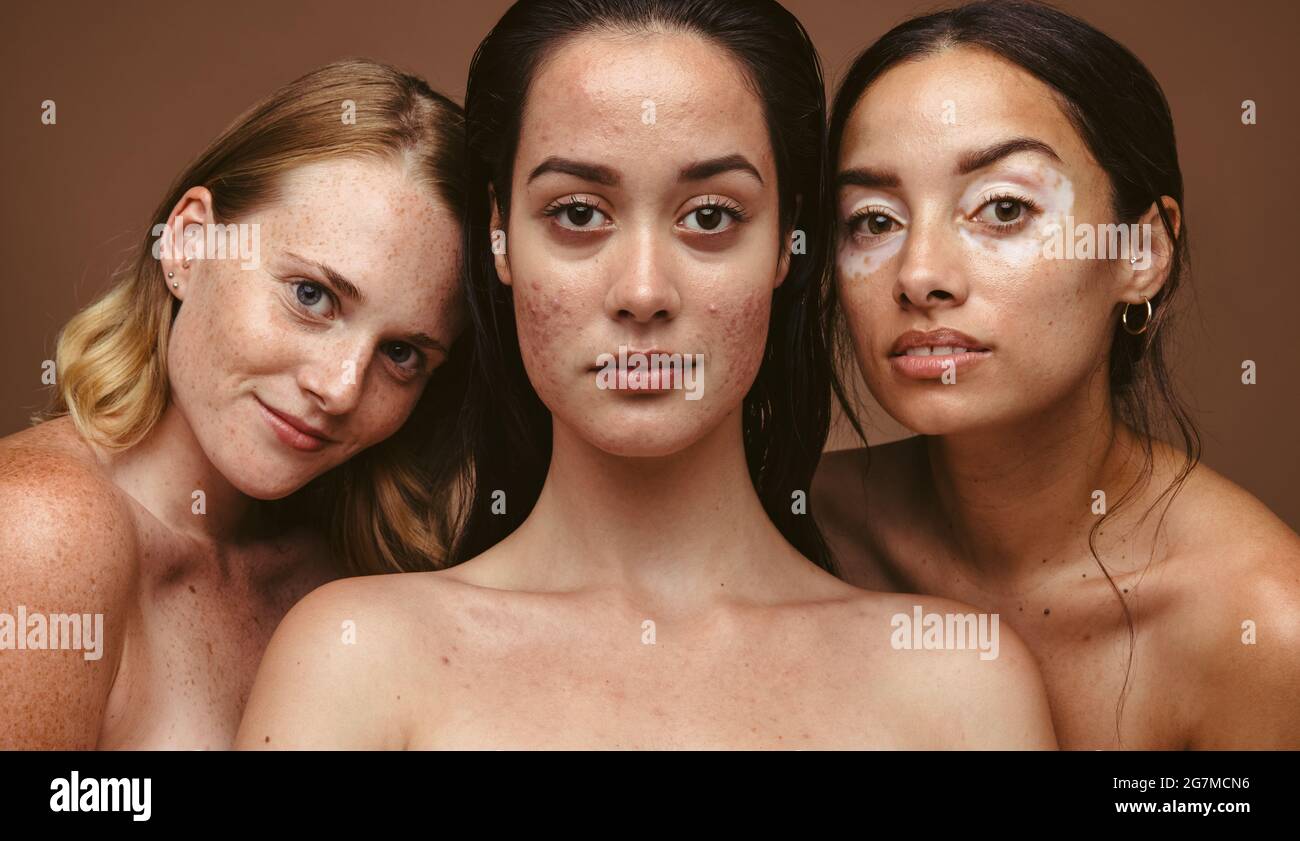 Ritratto di donne sorridenti con problemi di pelle insieme su sfondo marrone. Le donne con diversi tipi di pelle sembrano sicure e indisturbate. Foto Stock