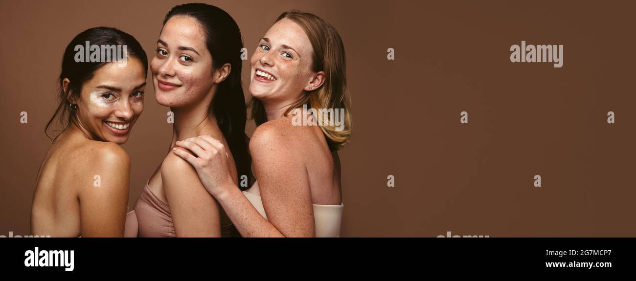 Panoramica di tre donne felici con problemi di pelle. Ritratto di donne sorridenti su sfondo marrone. Foto Stock