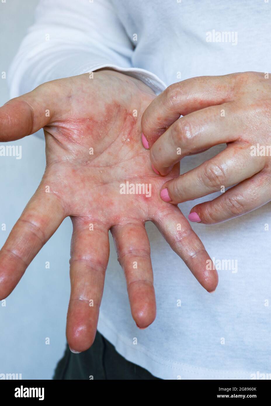 Donna che mostra le mani con Eczema, pelle rossa cracked con perdita di  linfa, concetto di salute Foto stock - Alamy
