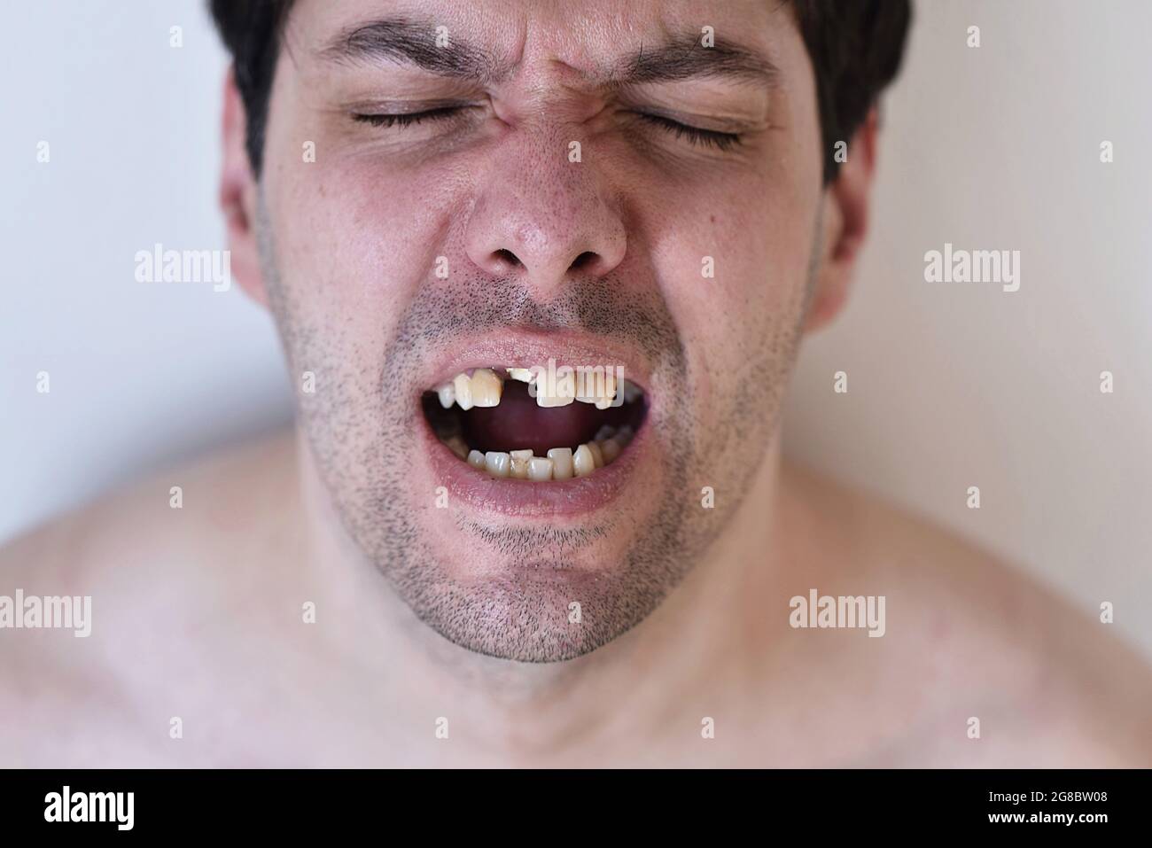 ritratto di un uomo con denti rotti Foto Stock