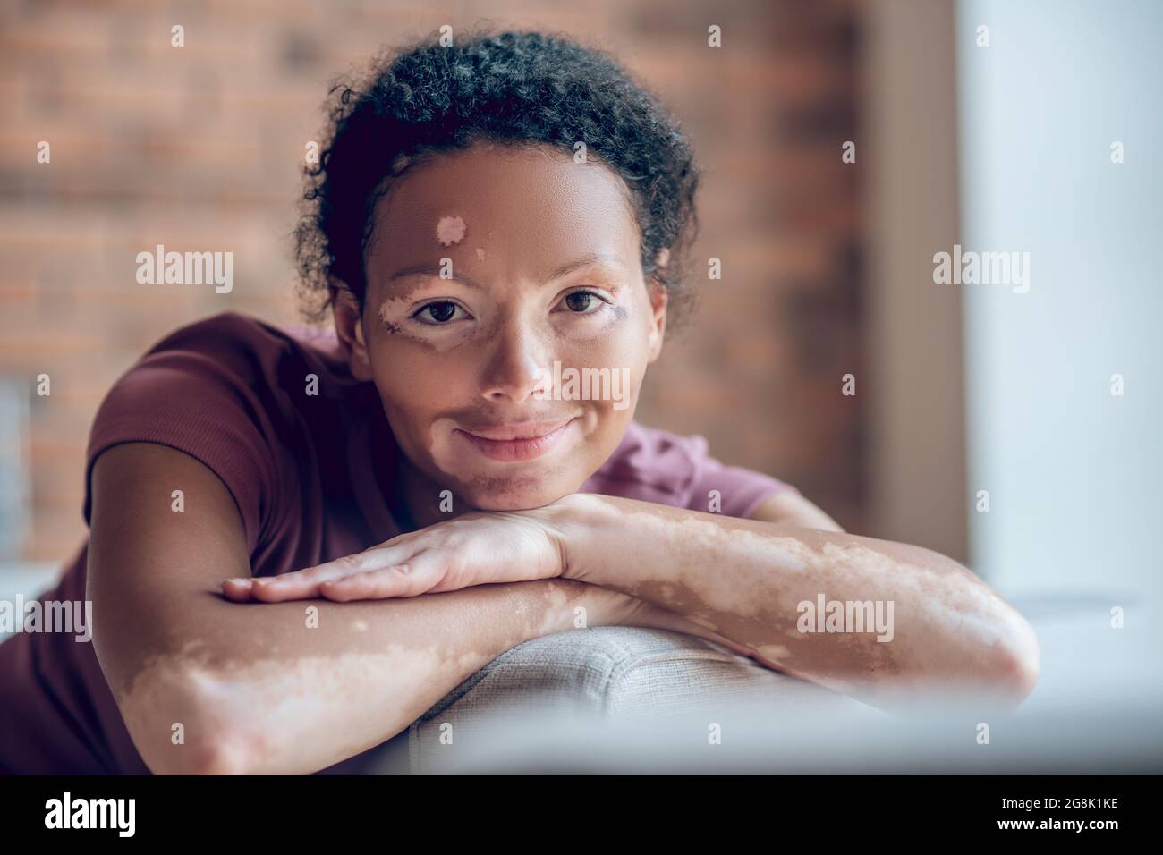 Carina giovane donna con pigmentazione sul viso che guarda candide e dolce Foto Stock