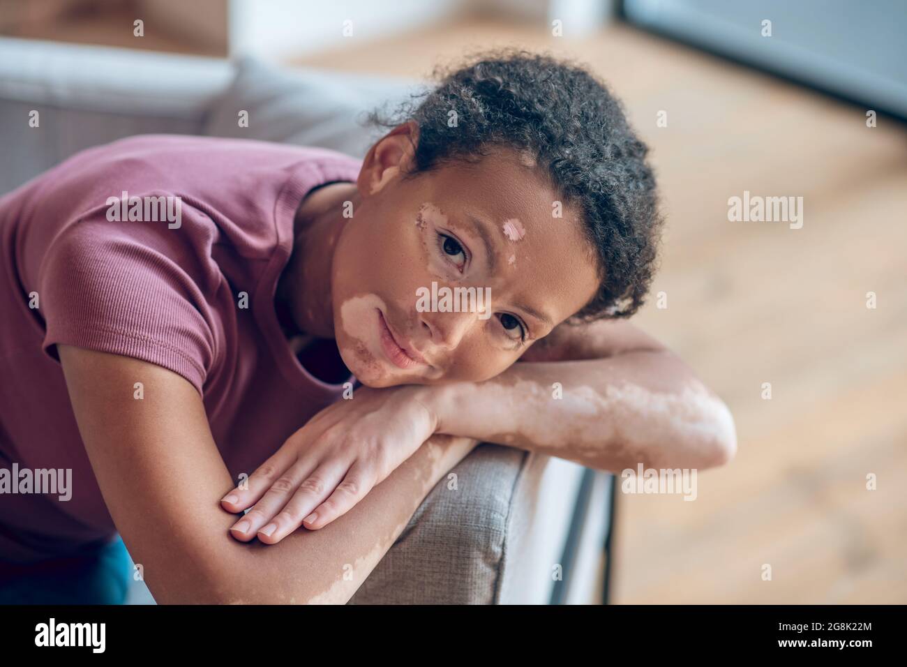 Giovane donna con pigmentazione sul viso che guarda candida e dolce Foto Stock