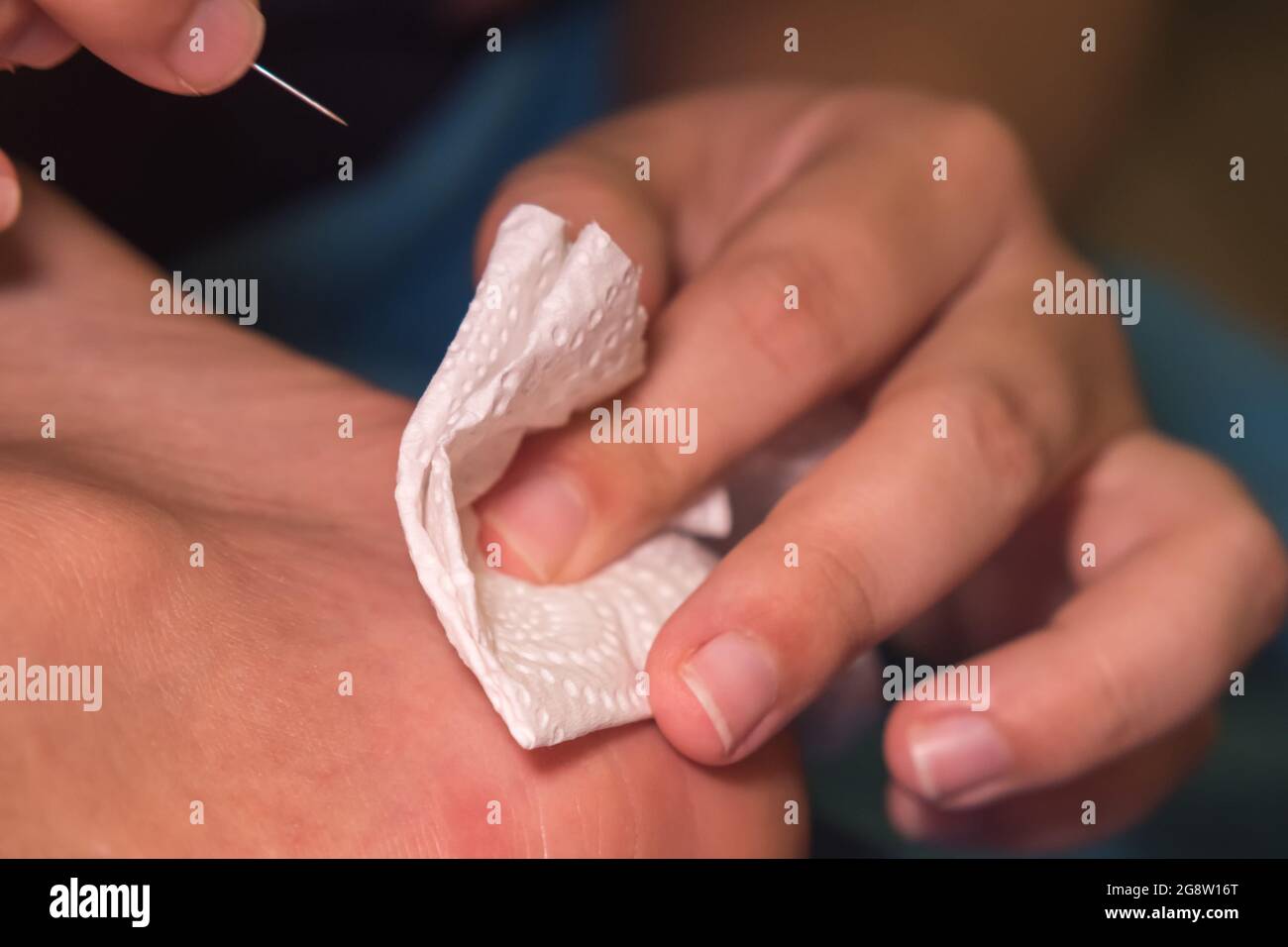 La mano di una donna preme un callo sul tallone che è stato appena forato con un ago con un tovagliolo. Primo piano Foto Stock