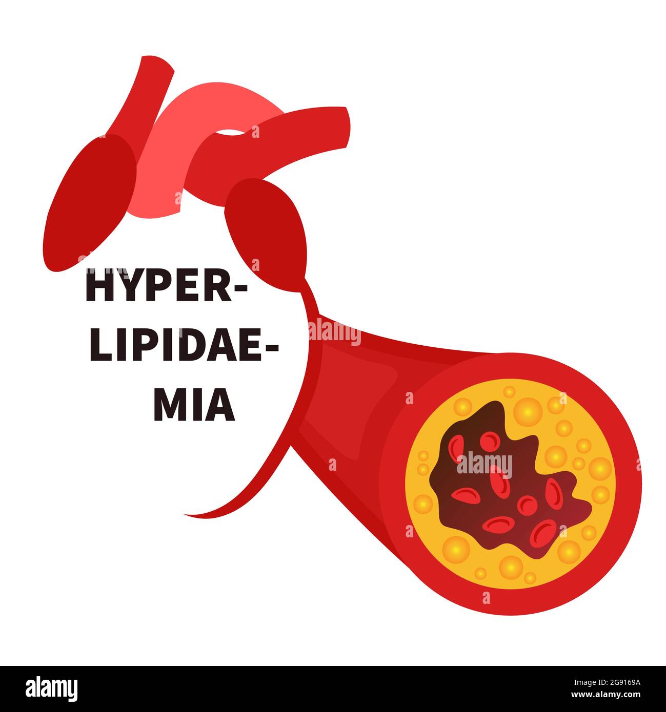 Iperlipidemia, illustrazione concettuale Foto Stock