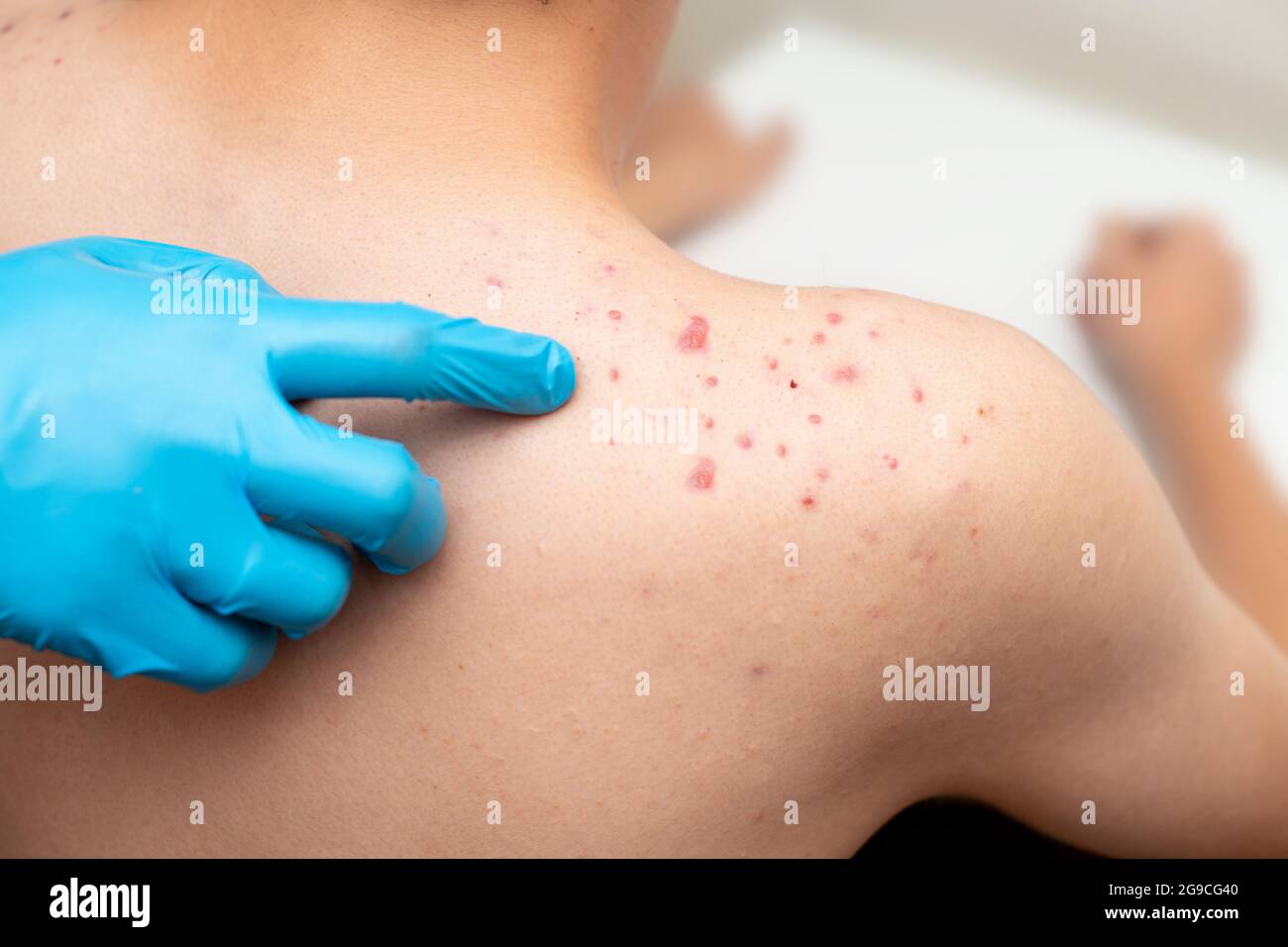 Teenage acne-acne sulla spalla di un uomo giovane ad un appuntamento del medico in una clinica per il trattamento di un problema. Foto Stock