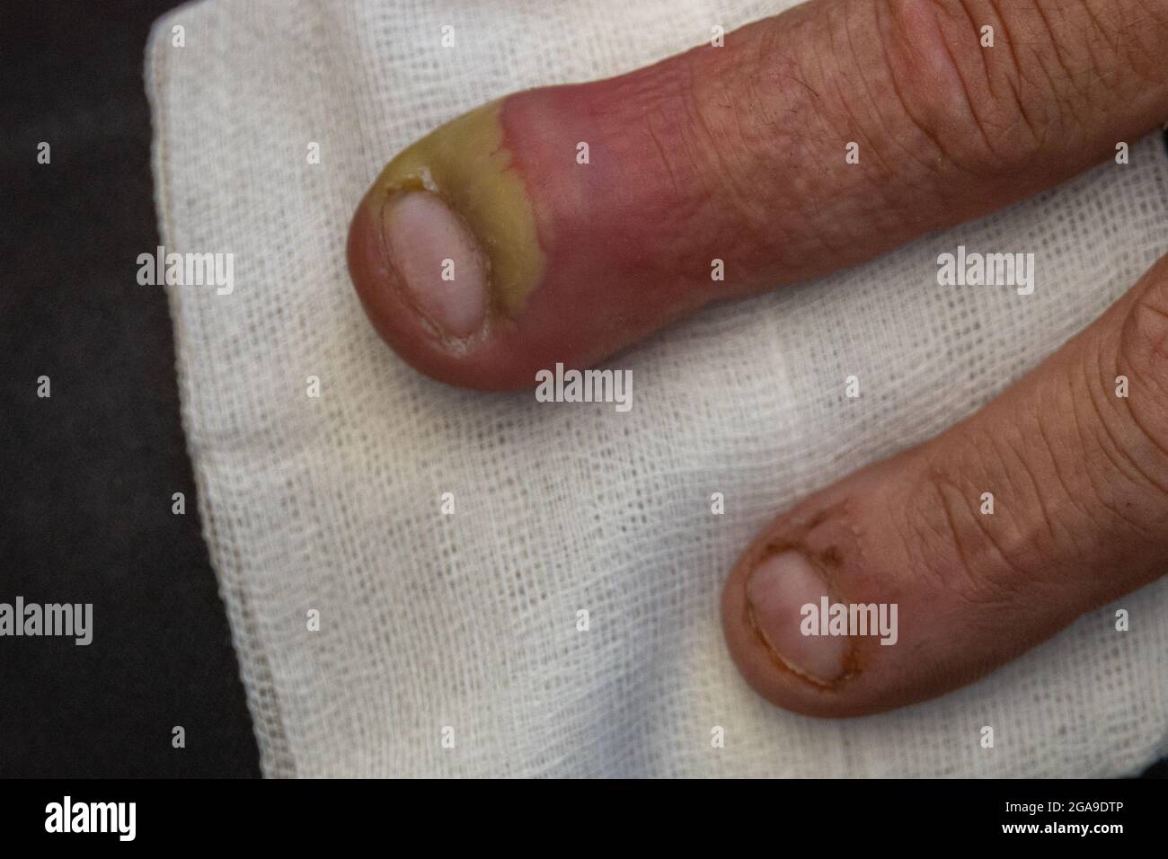 gonfiore del dito di una mano a causa di infezione dermatologica da un pus riempito unghia e batteri infettivi concetto di assistenza sanitaria Foto Stock