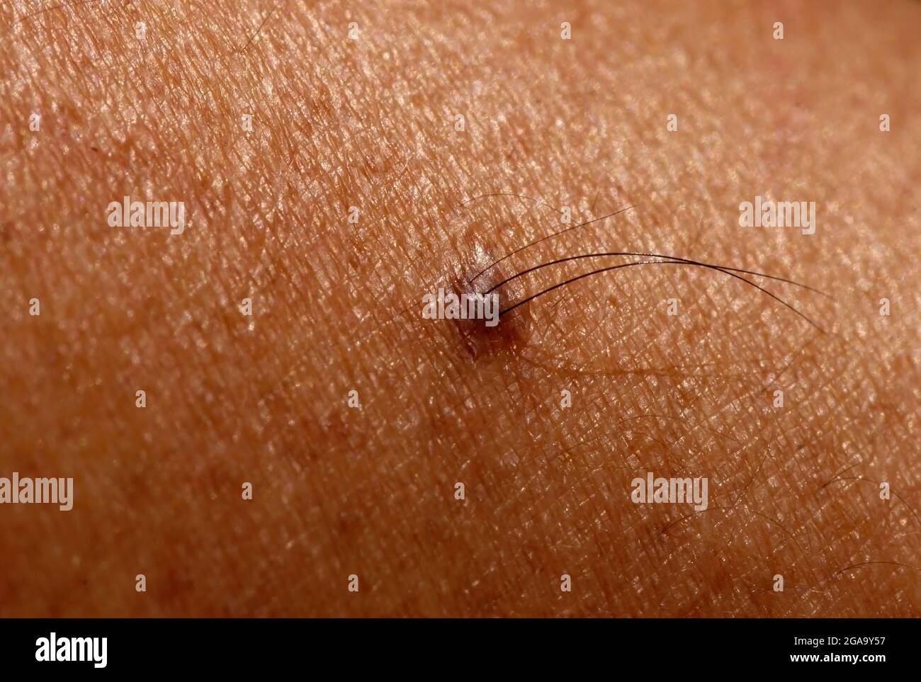 Vista closeup di una talpa sulla pelle con i capelli, messa a fuoco  selezionata Foto stock - Alamy