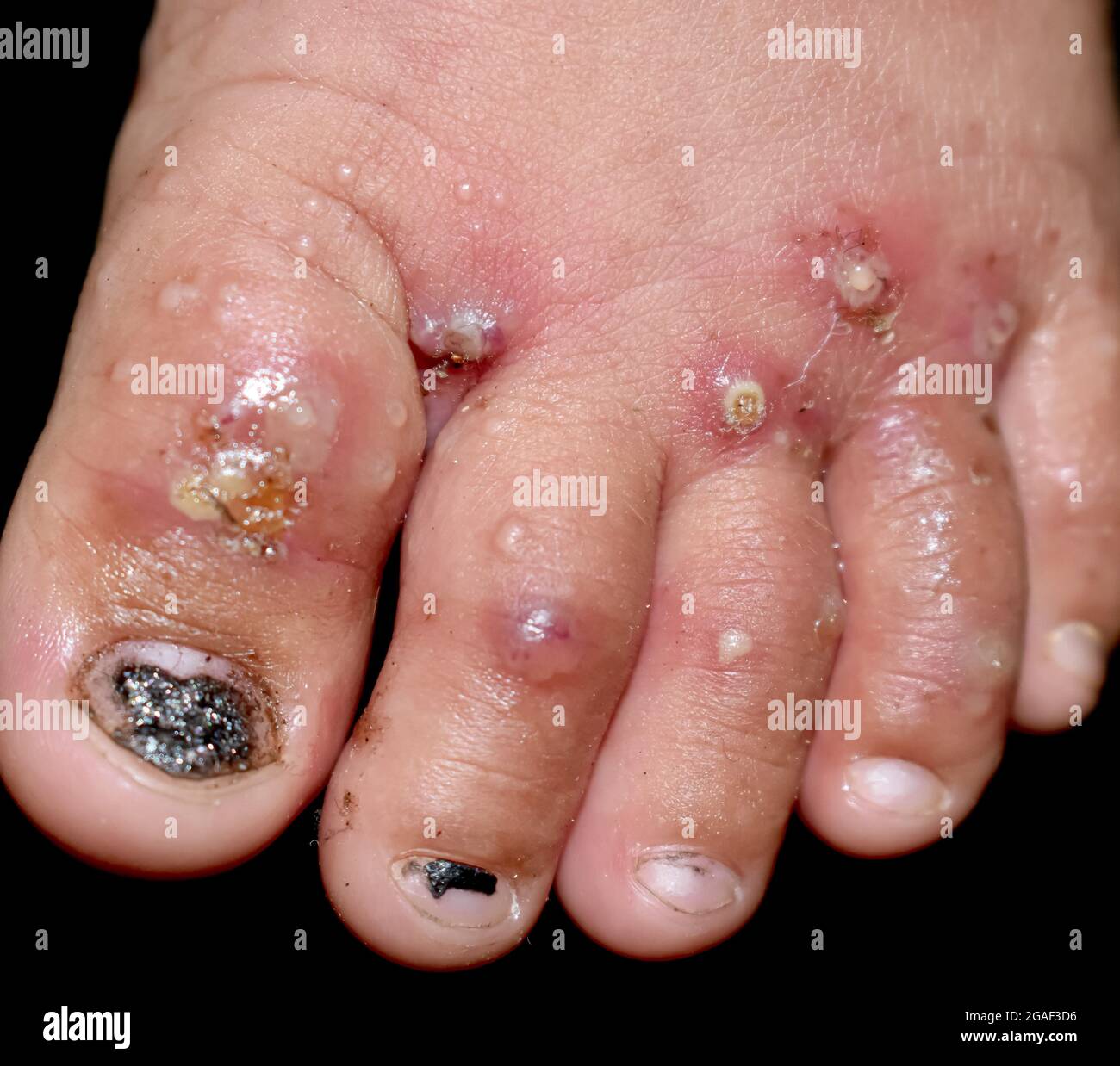 Infestazione di scabbia con infezione batterica secondaria o sovrapposta e  pustole ai piedi del sud-est asiatico, bambino birmano. Una pelle contagiosa  Foto stock - Alamy