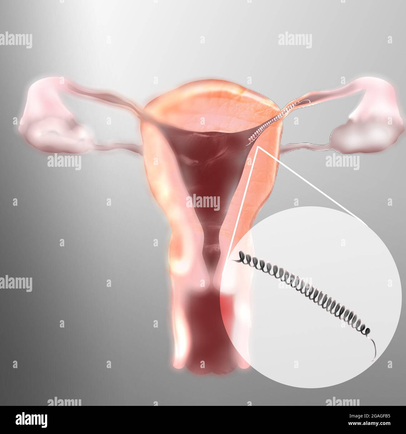 Essure controllo permanente delle nascite Foto Stock