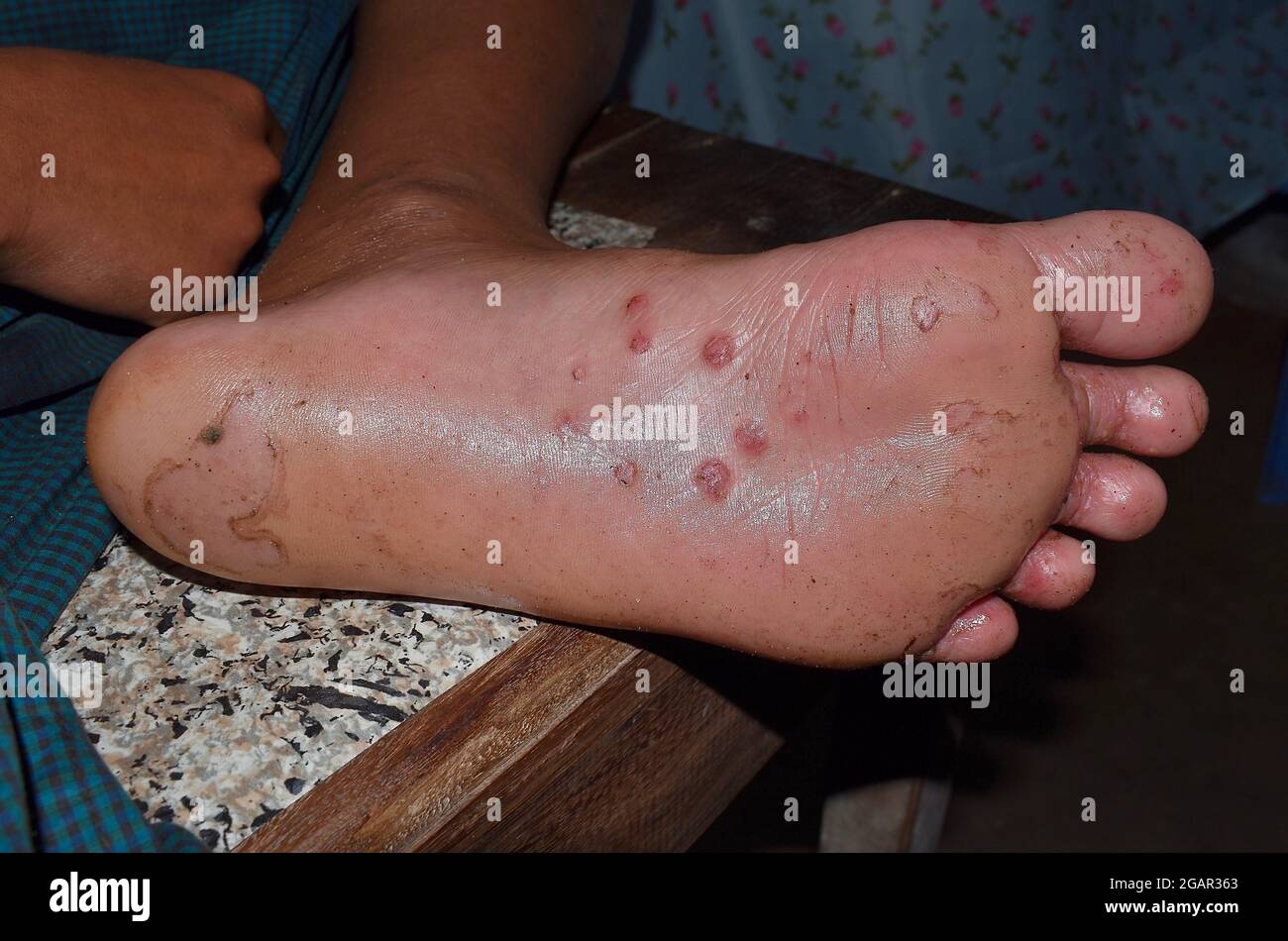 Infestazione di scabbia con infezione secondaria o fungina o pedis di tinea ai piedi dell'uomo del Sudest asiatico. Isolato su sfondo nero Foto Stock