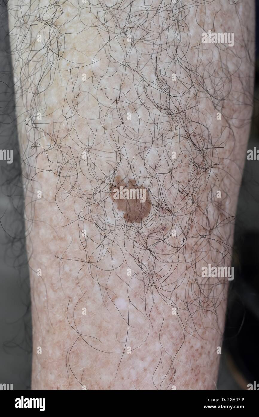 Punto di età o nevo sulla gamba con la pelle pelosa dell'uomo anziano  asiatico. Sono macchie marroni, grigie o nere e chiamati macchie di fegato,  lentigo senile, lentig solare Foto stock -