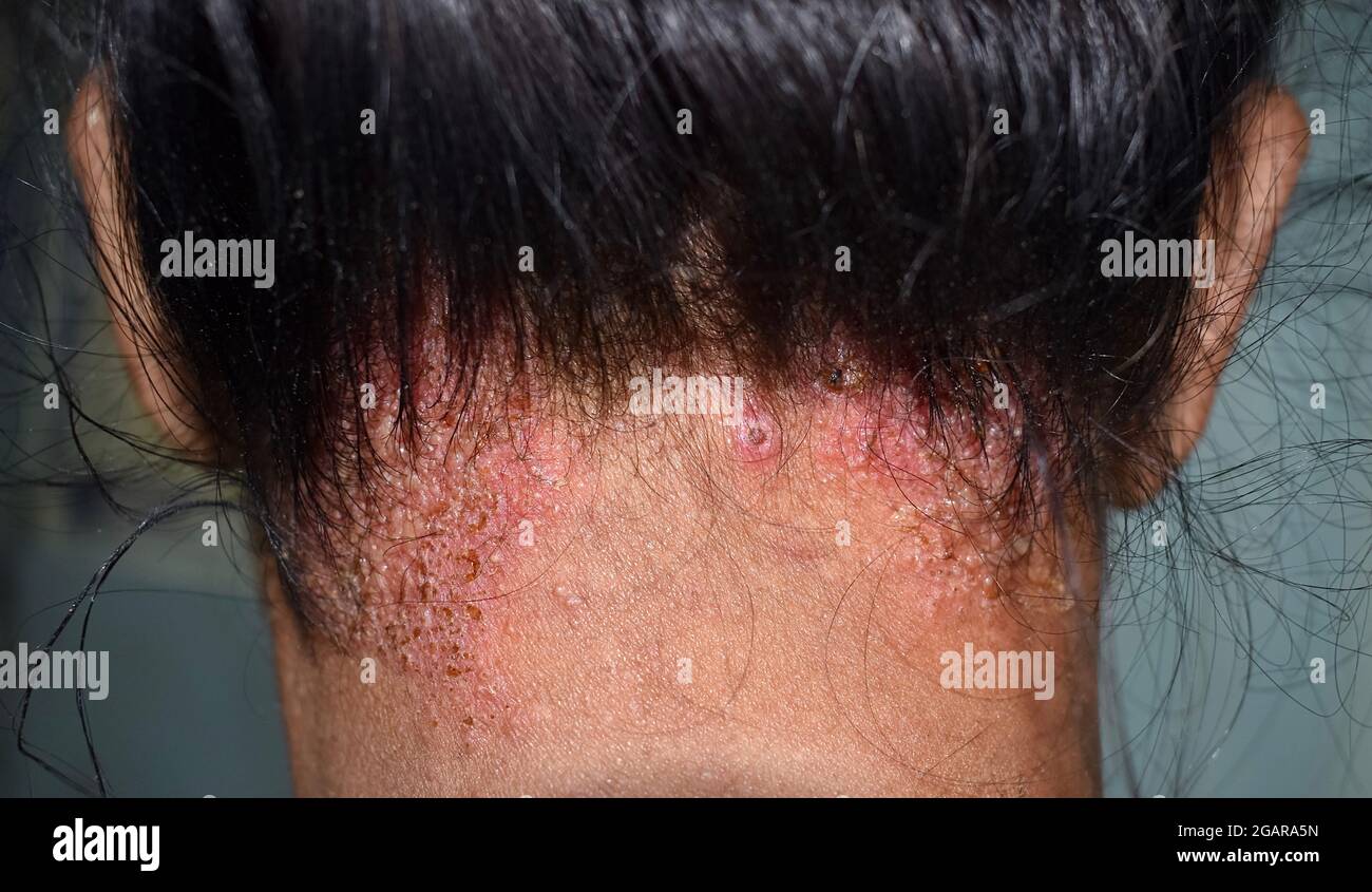 Dermatite seborrheic o infezione fungina della pelle al cuoio capelluto del Sudest asiatico, Myanmar paziente adulto femminile. Vista posteriore. Foto Stock