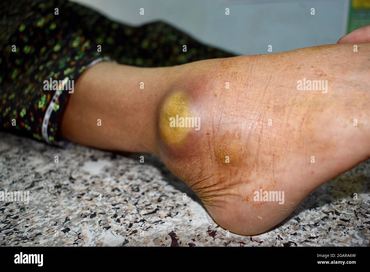 Ascesso grande e cellulite ai piedi del paziente maschile anziano birmano asiatico in una clinica di Myanmar. Foto Stock