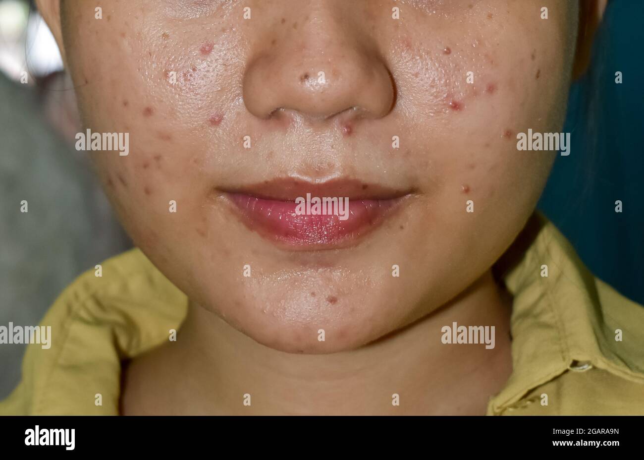 Vulgaris dell'acne e macchie nere su faccia intera della donna del sud-est asiatico. L'acne si verifica quando i follicoli dei capelli diventano tappati con l'olio e le cellule morte. IT cau Foto Stock