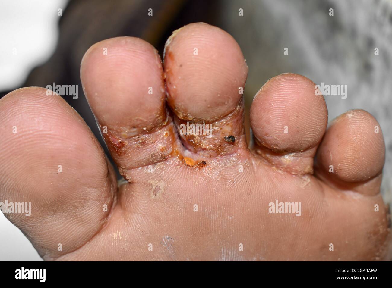 Fungo Tra Le Dita Dei Piedi Immagini e Fotos Stock Alamy