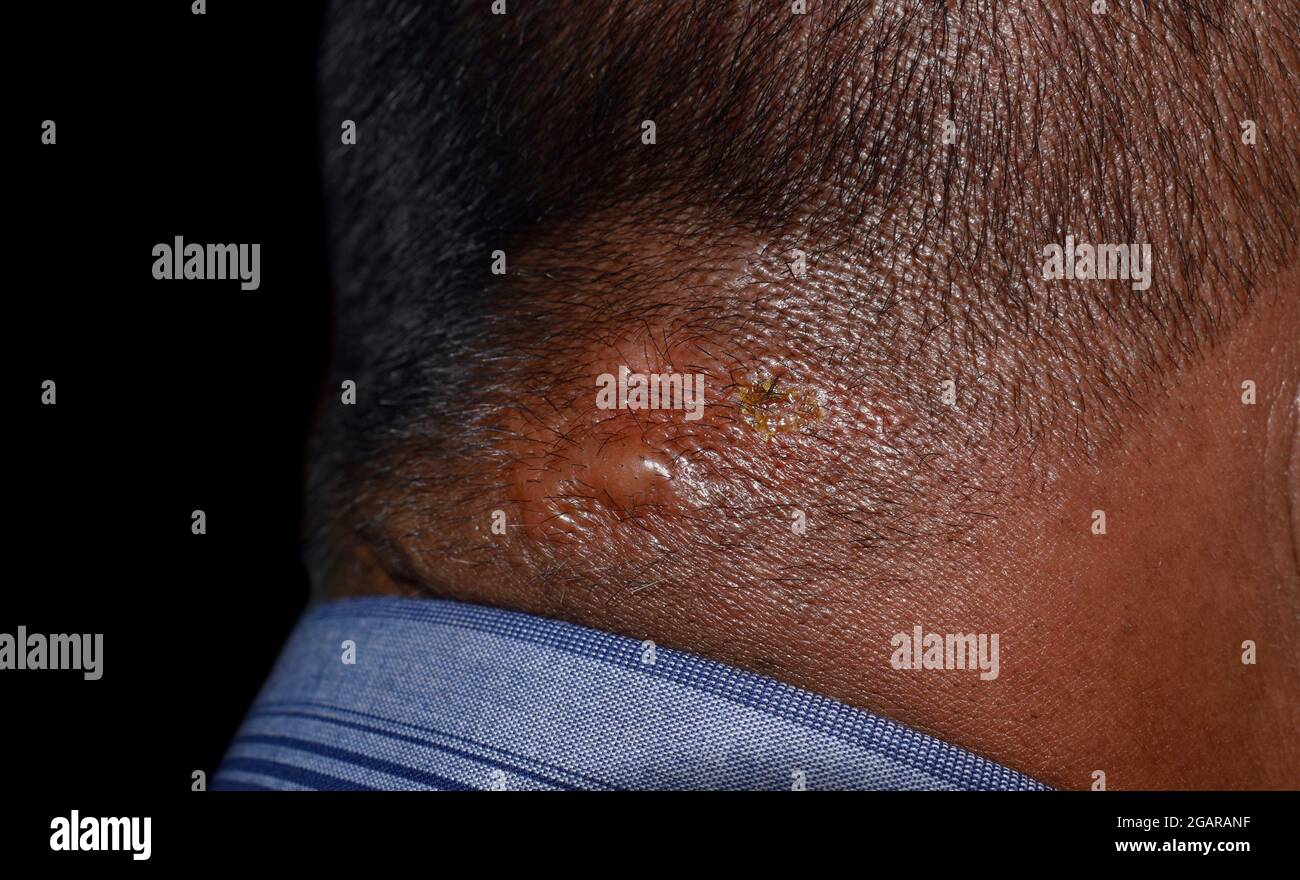 Dermatite seborrheic alla nuca del Sudest asiatico, Myanmar paziente adulto di sesso maschile. Vista laterale destra. Foto Stock