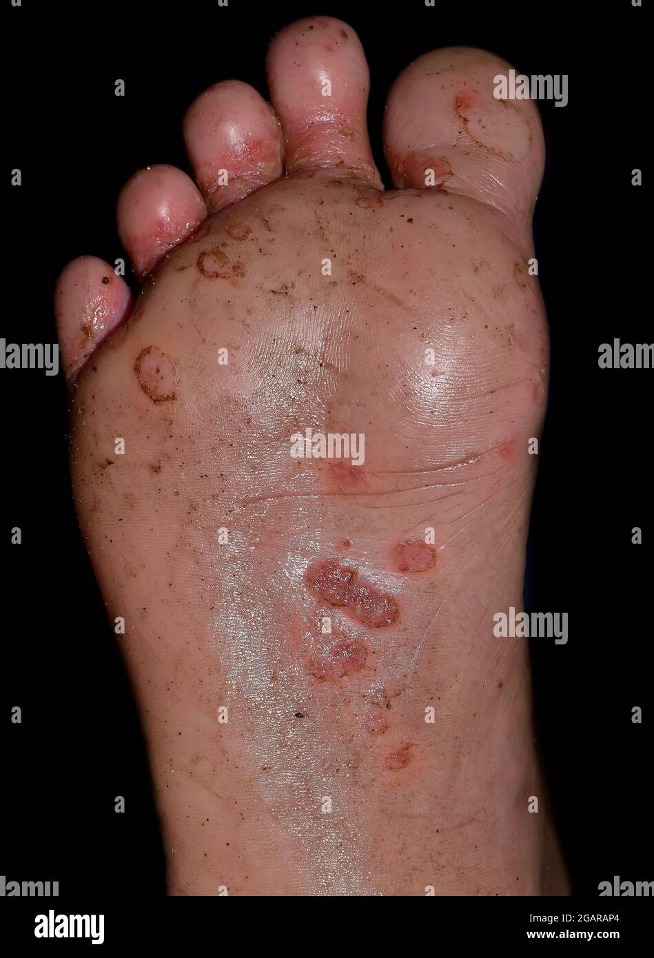 Infestazione di scabbia con infezione secondaria o fungina o pedis di tinea ai piedi dell'uomo del Sudest asiatico. Isolato su sfondo nero Foto Stock