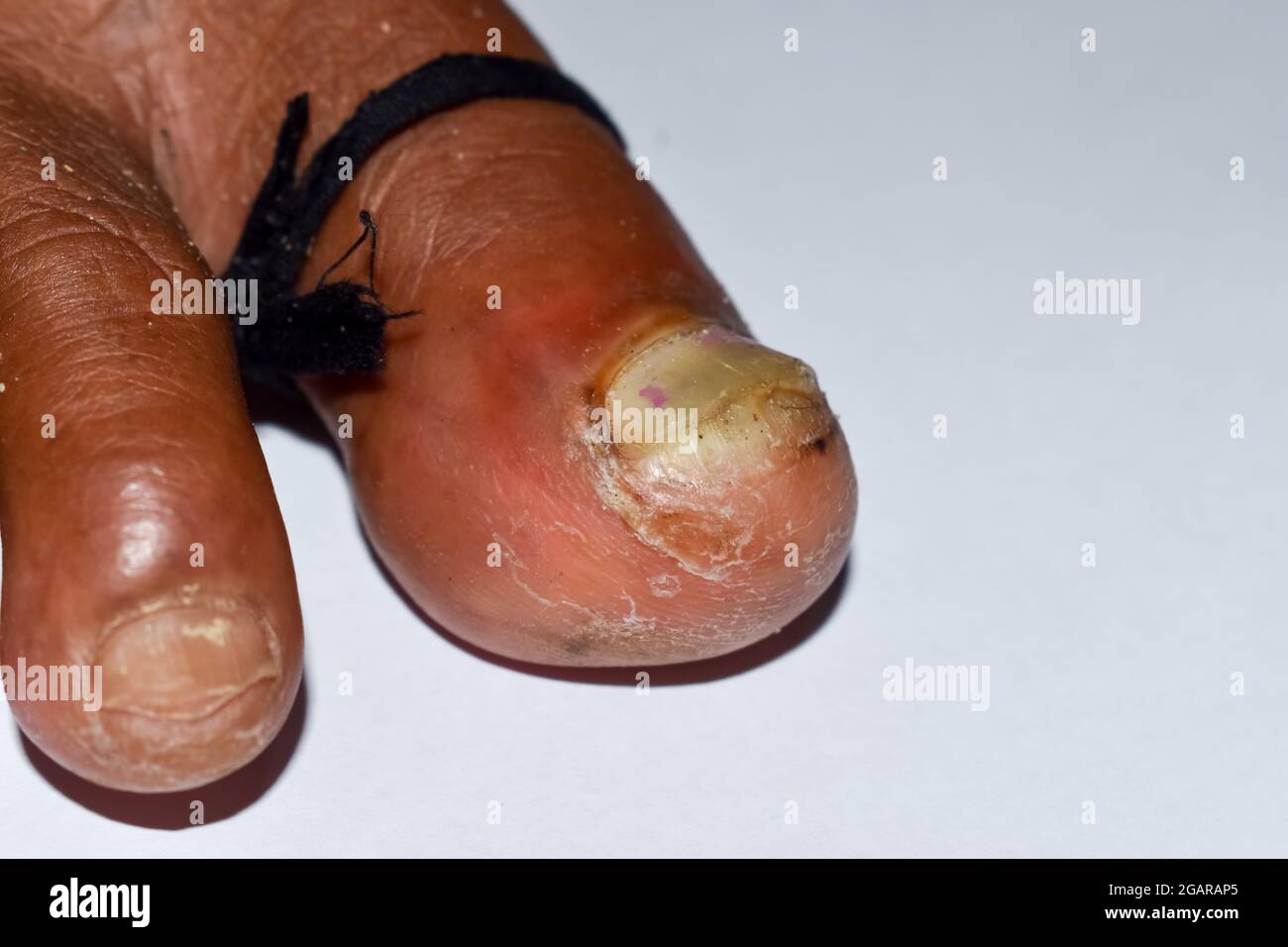 Paronichia acuta al piede grosso e pedis del piede o della linea dell'atleta fra le dita dell'uomo del Sud-est asiatico. Vista in primo piano. Foto Stock