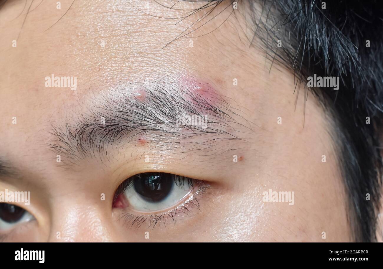 Acne meccanica o sport-indotti acne o whitheads o acne lieve a sopracciglia zona di faccia nel Sudest asiatico, cinese giovane uomo. Foto Stock