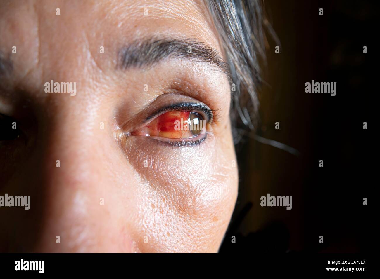 Primo piano di un grave colpo di sangue occhio. Blefarite, una condizione di congiuntivite in una donna dopo il vaccino covid Foto Stock