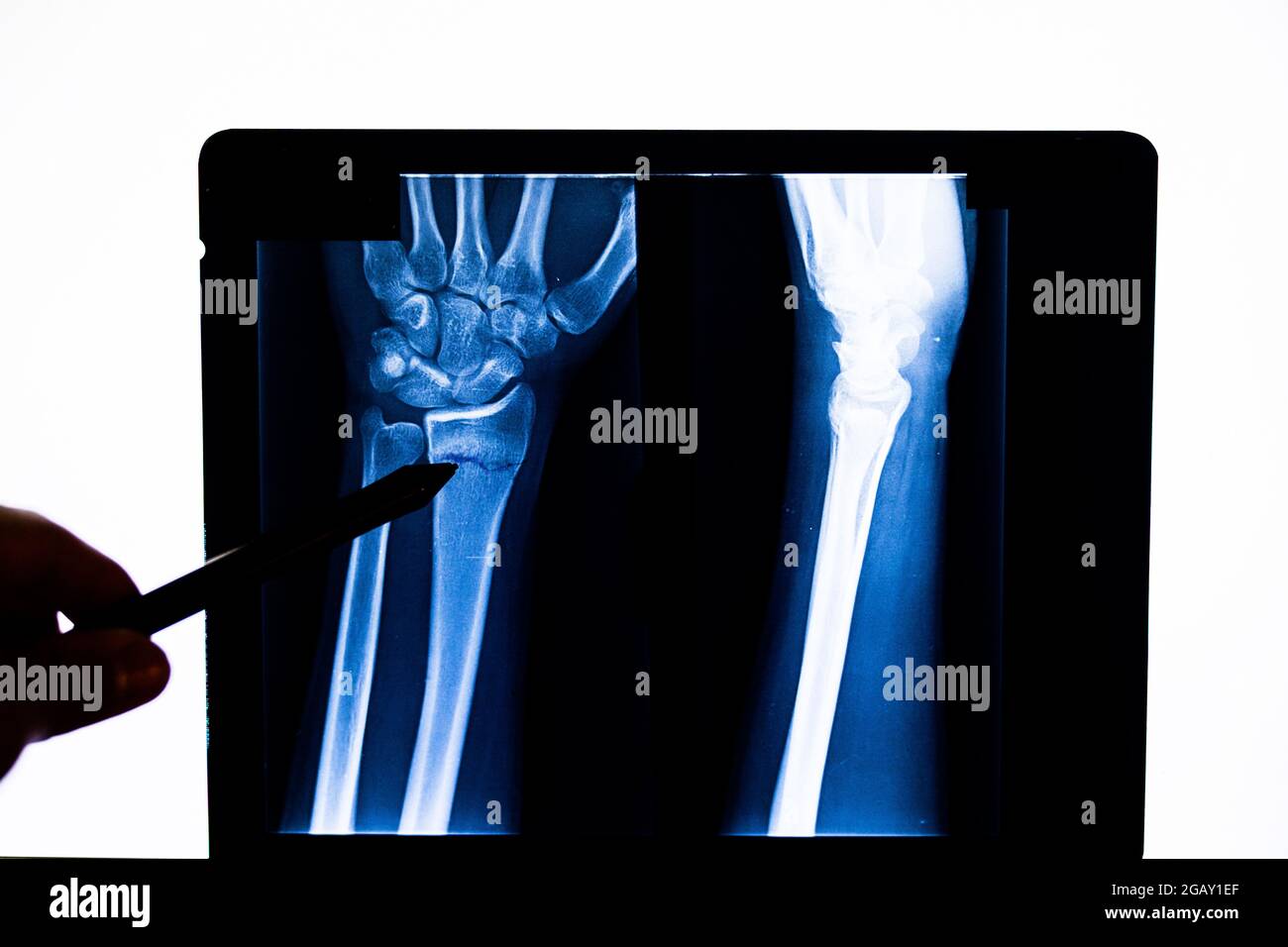 Controllo medico della radiografia esame della pellicola radiografica del  braccio del paziente che punta alla frattura