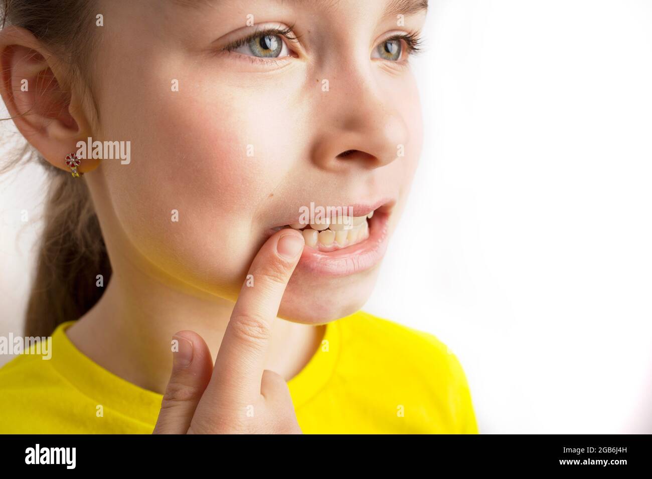 Bambini denti storti, odontoiatria pediatrica. Foto Stock