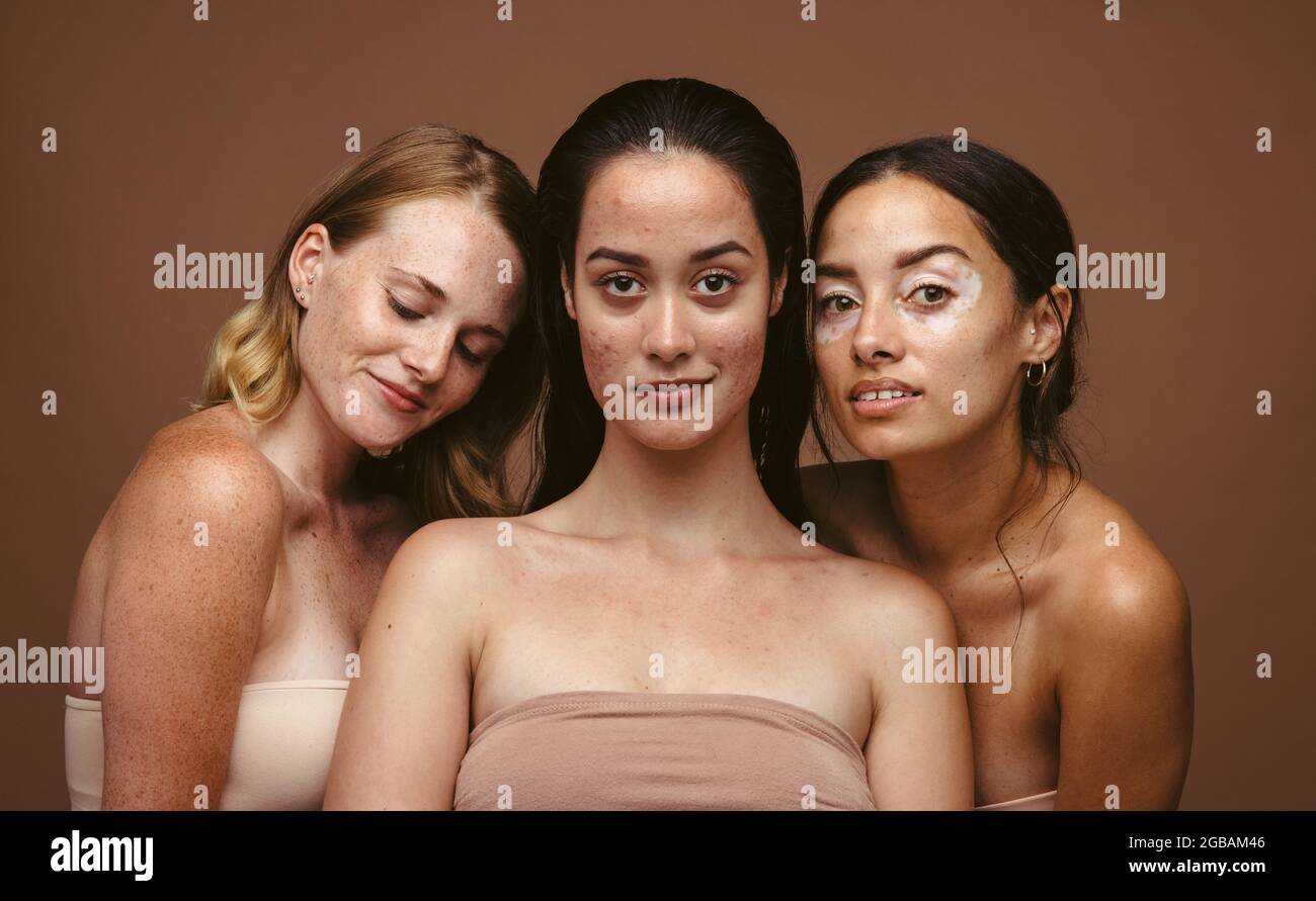Donne giovani sicure con disturbi della pelle che riflettono la positività del corpo e l'autoaccettazione. Primo piano di tre donne che hanno problemi di pelle in piedi insieme Foto Stock