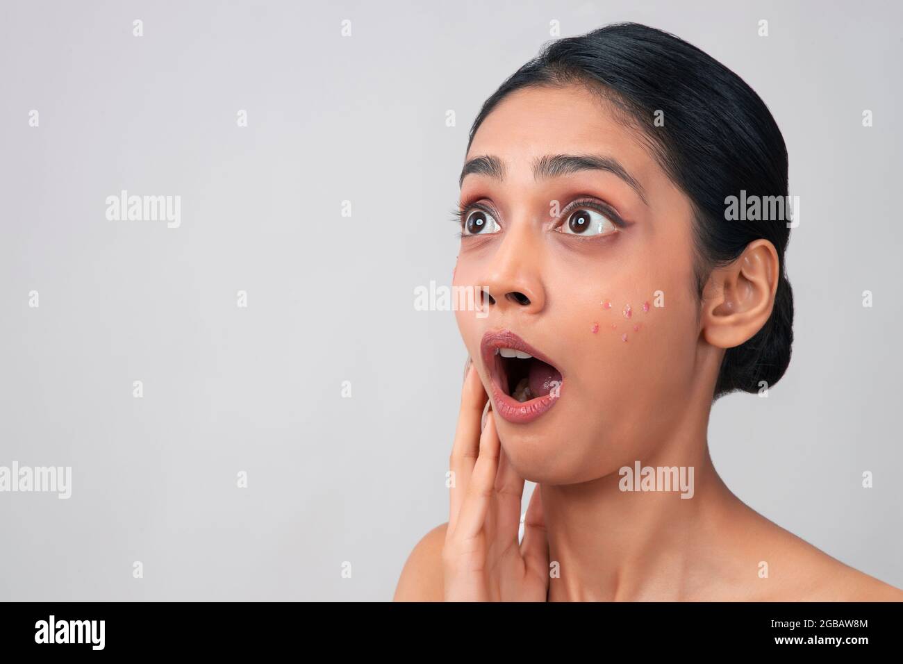 Una giovane donna ha scioccato a causa di pimples sul suo viso. Foto Stock