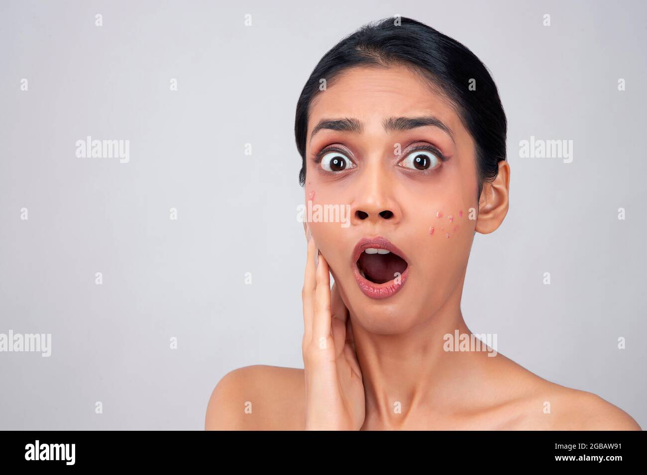 Una giovane donna ha scioccato a causa di pimples sul suo viso. Foto Stock