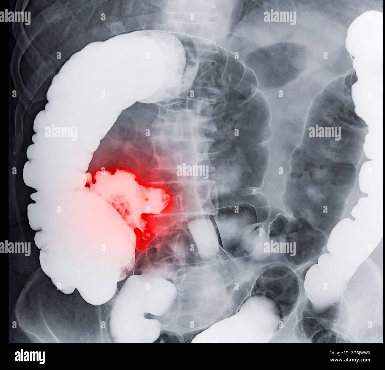 L'enema del bario ha dimostrato il cecum ed il colon per il cancro colorettale di diagnosi o il cancro del colon. Foto Stock