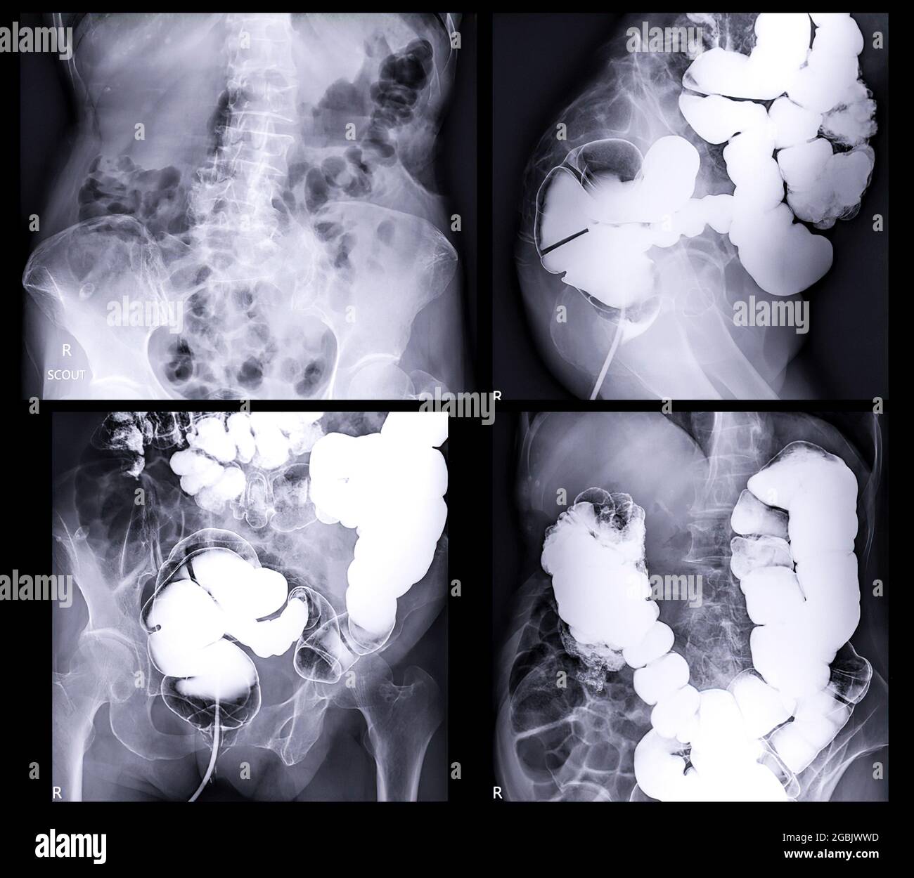 L'enema del bario ha dimostrato il cecum ed il colon per il cancro colorettale di diagnosi o il cancro del colon. Foto Stock