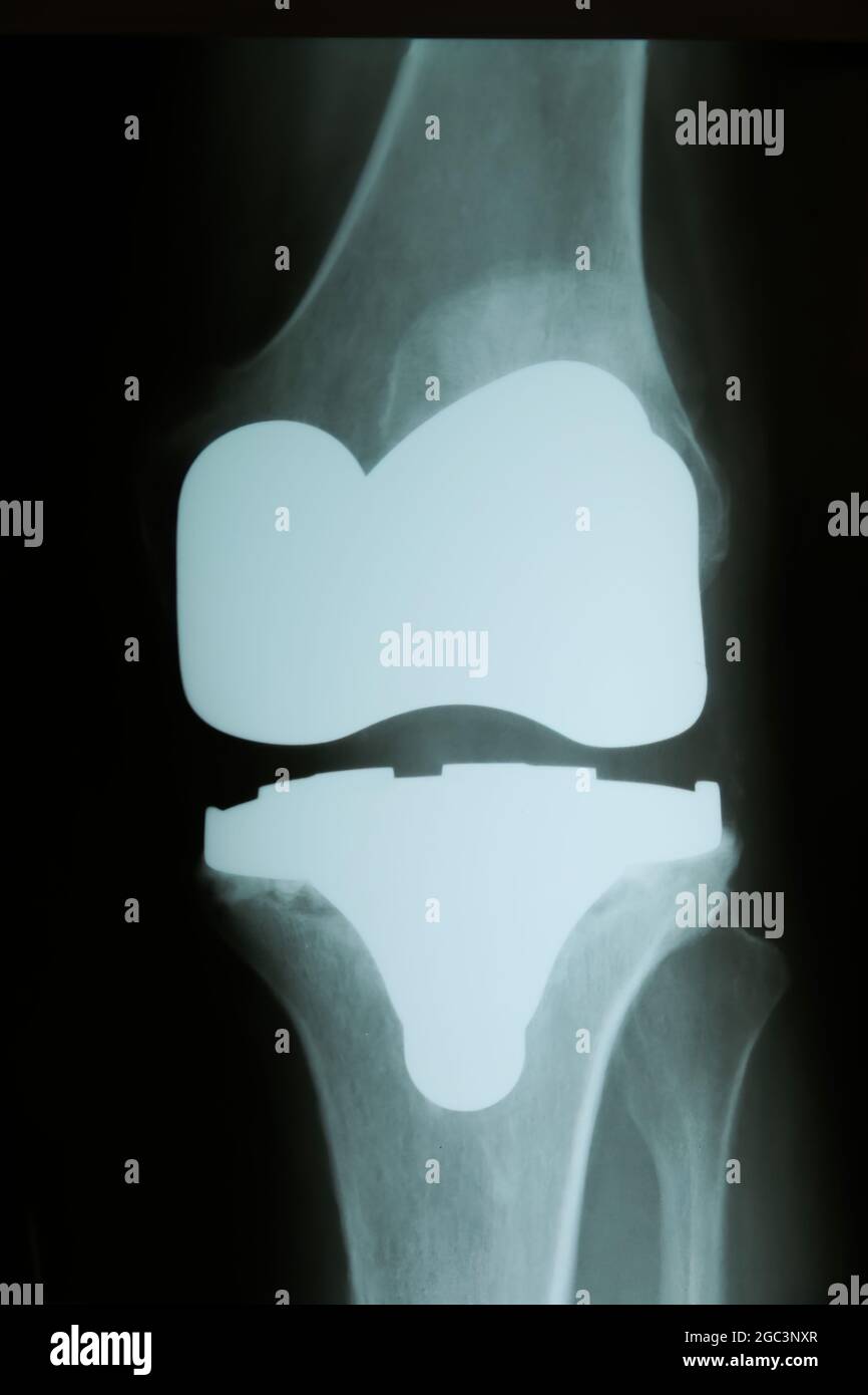 Immagine a raggi X del ginocchio con artificiale completa sostituzione dell'articolazione (endoprotesi) in caso di artrosi (degenerazione misto) Foto Stock