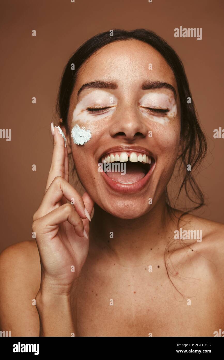 Ritratto di giovane donna con vitiligine che applica la crema sulla guancia. Donna allegra con vitiligo che rappresenta l'accettazione di sé e la positività del corpo. Foto Stock