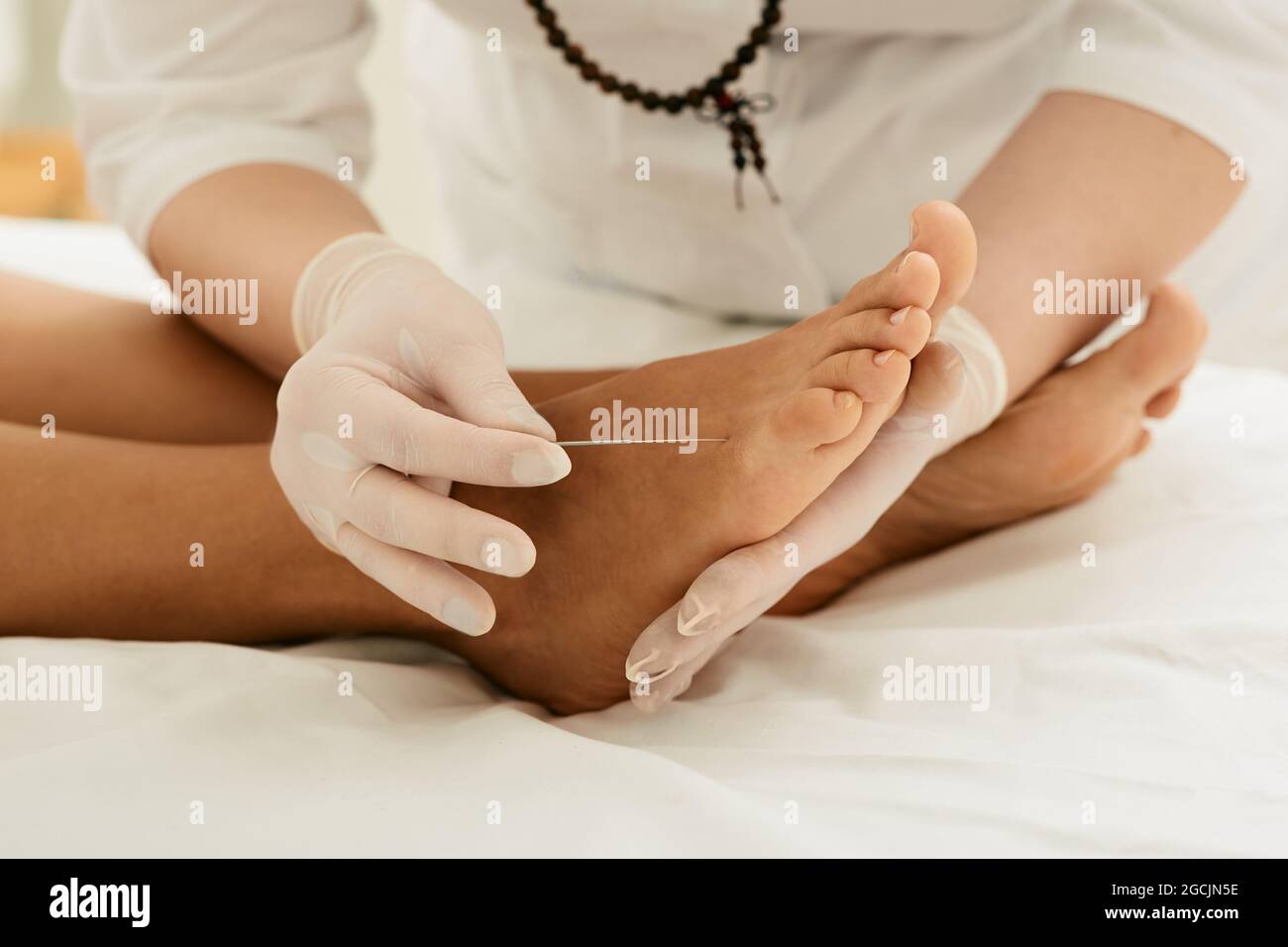 Chiropractor che fa la terapia di agopuntura per i piedi femminili con gli aghi. Trattamento dell'agopuntura per il dolore cronico del piede Foto Stock