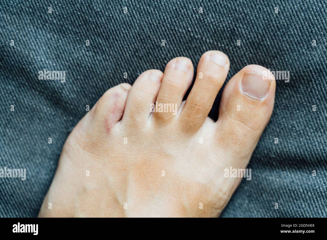 Lesioni alle dita dei piedi. Dolore e lividi al dito del piede dopo un  incidente a casa. Frattura di Falange. Unghie a piedi nudi sano Foto stock  - Alamy