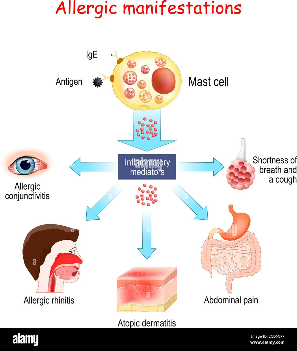 Allergia alimentare e manifestazioni allergeniche. Mastociti e mediatori infiammatori. Congiuntivite allergica, dermatite atopica, rinite allergica. Vettore Illustrazione Vettoriale