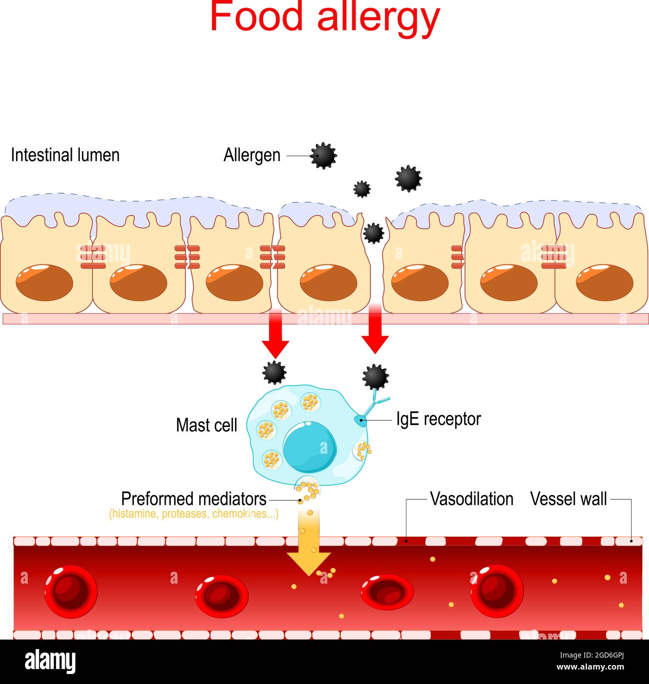 Allergia alimentare e perdite intestinali. Risposta immunitaria anomala al cibo. Illustrazione vettoriale Illustrazione Vettoriale