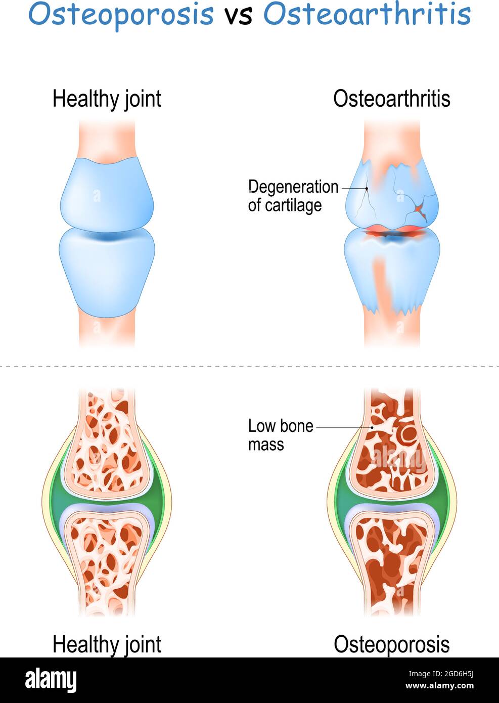 Osteoporosi vs osteoartrite confronto e differenza tra le malattie articolari sane e degenerative della cartilagine, e le articolazioni con bassa massa ossea Illustrazione Vettoriale