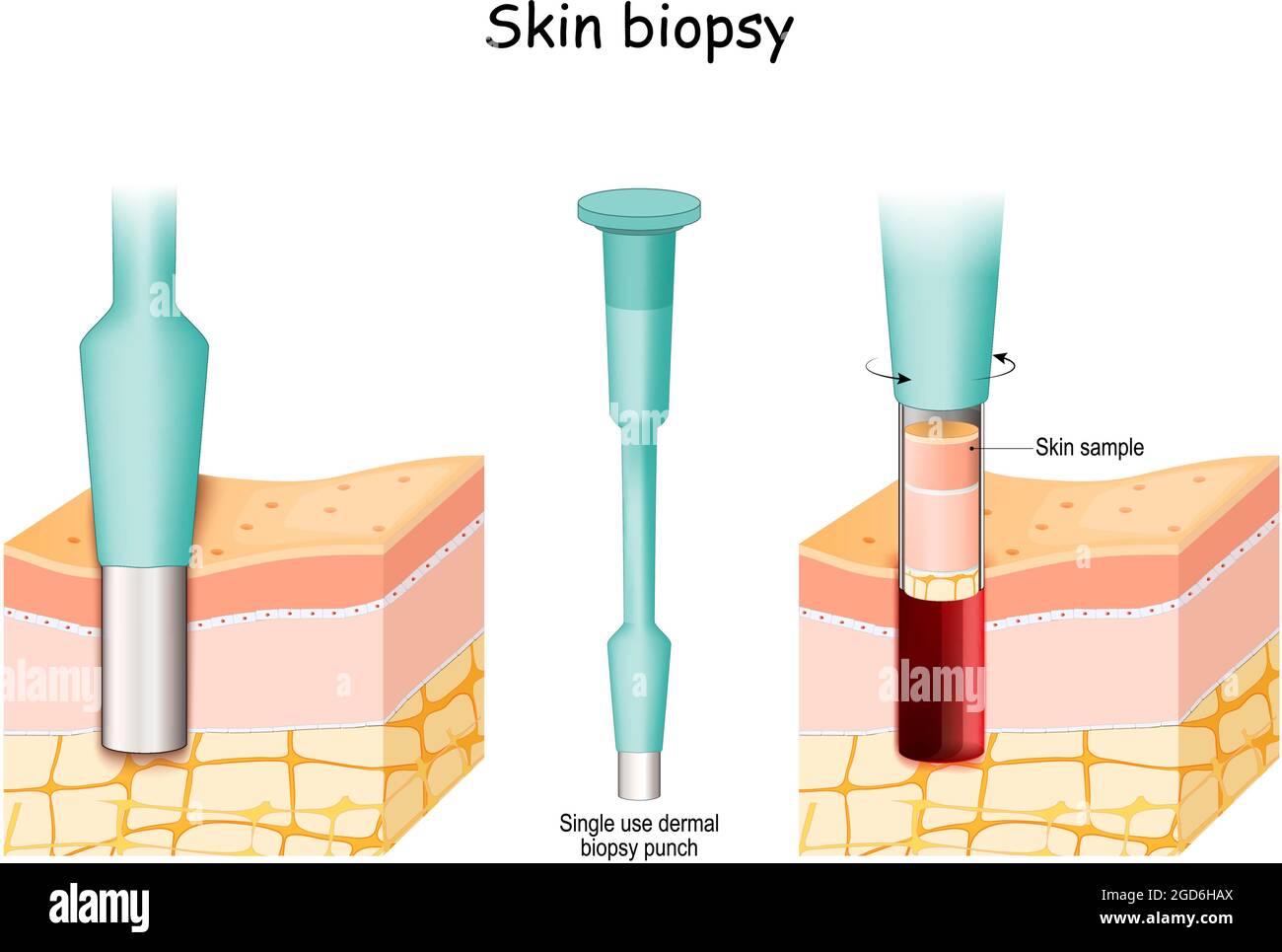 Biopsia cutanea. Biopsia punzonata prelevare il campione cutaneo. Pelle prima e dopo la procedura medica. Primo piano del punch bioptico dermico monouso. Cura del cancro. Illustrazione Vettoriale