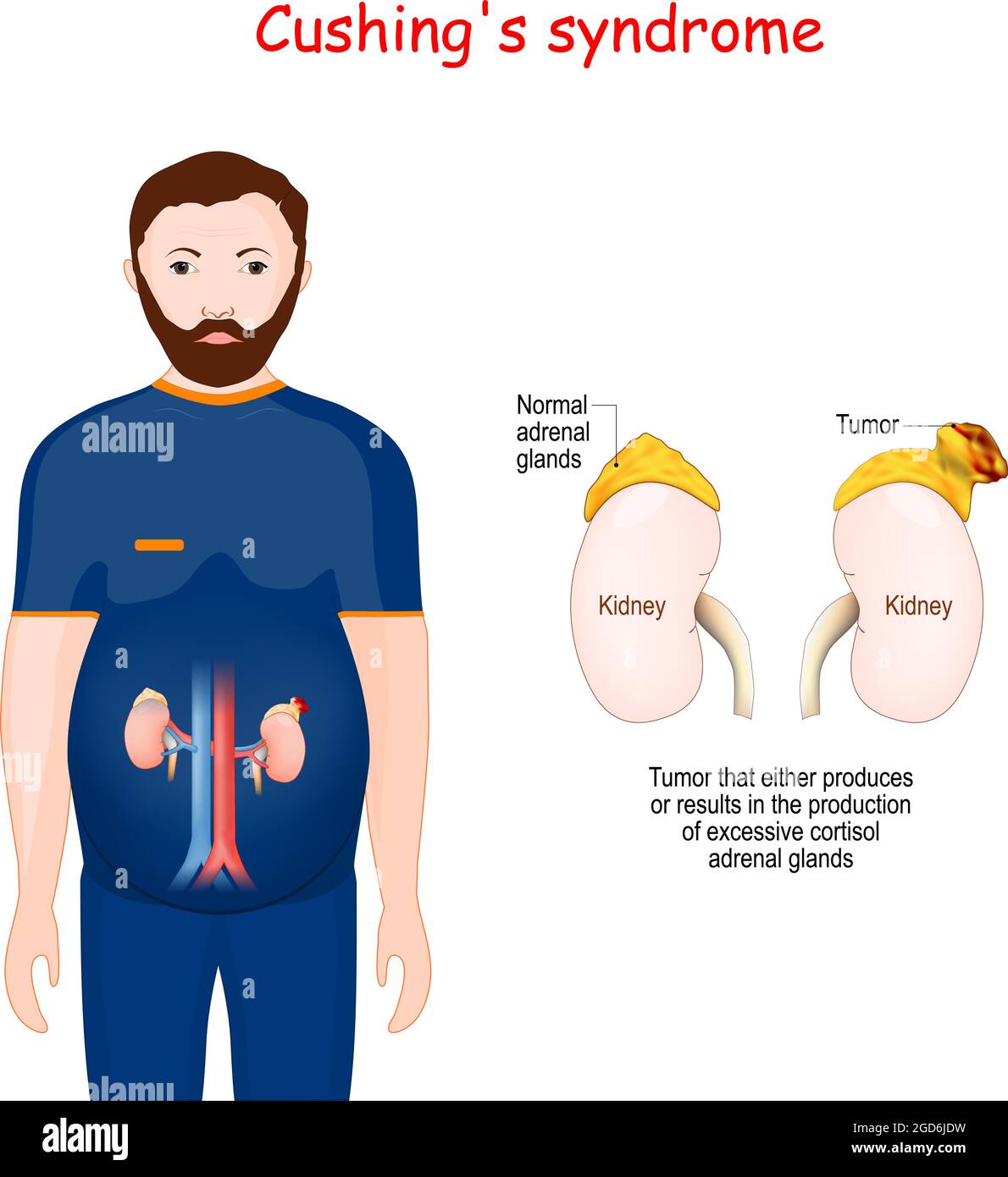 Malattia dell'osso renale immagini e fotografie stock ad alta