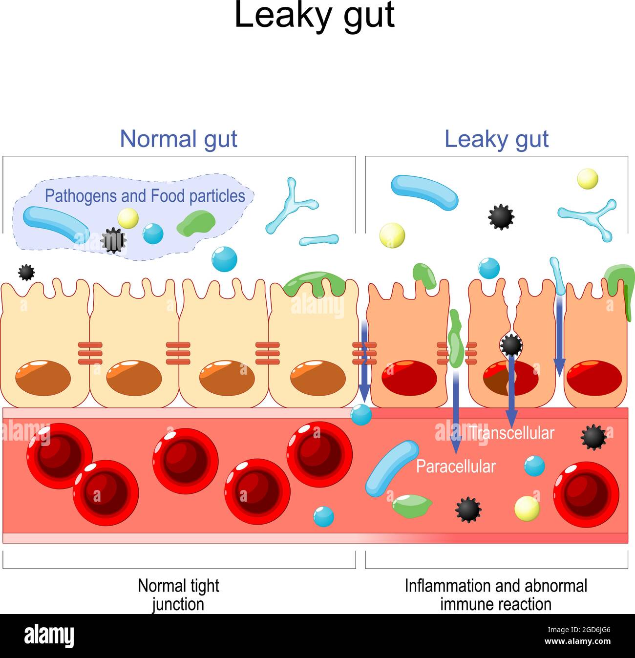 perdite intestinali. cellule sul rivestimento intestinale tenute strettamente insieme. in intestino con celiachia e sensibilità al glutine queste giunzioni strette Illustrazione Vettoriale