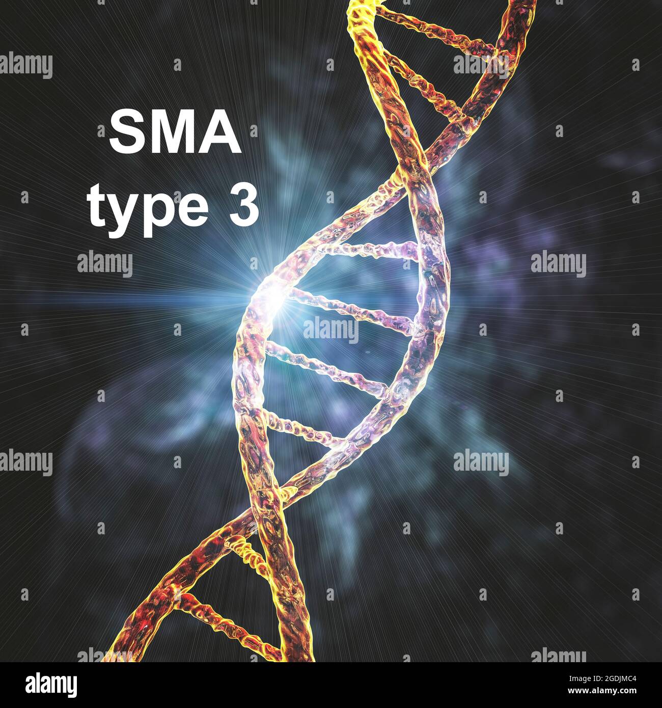 Atrofia muscolare spinale, illustrazione Foto Stock