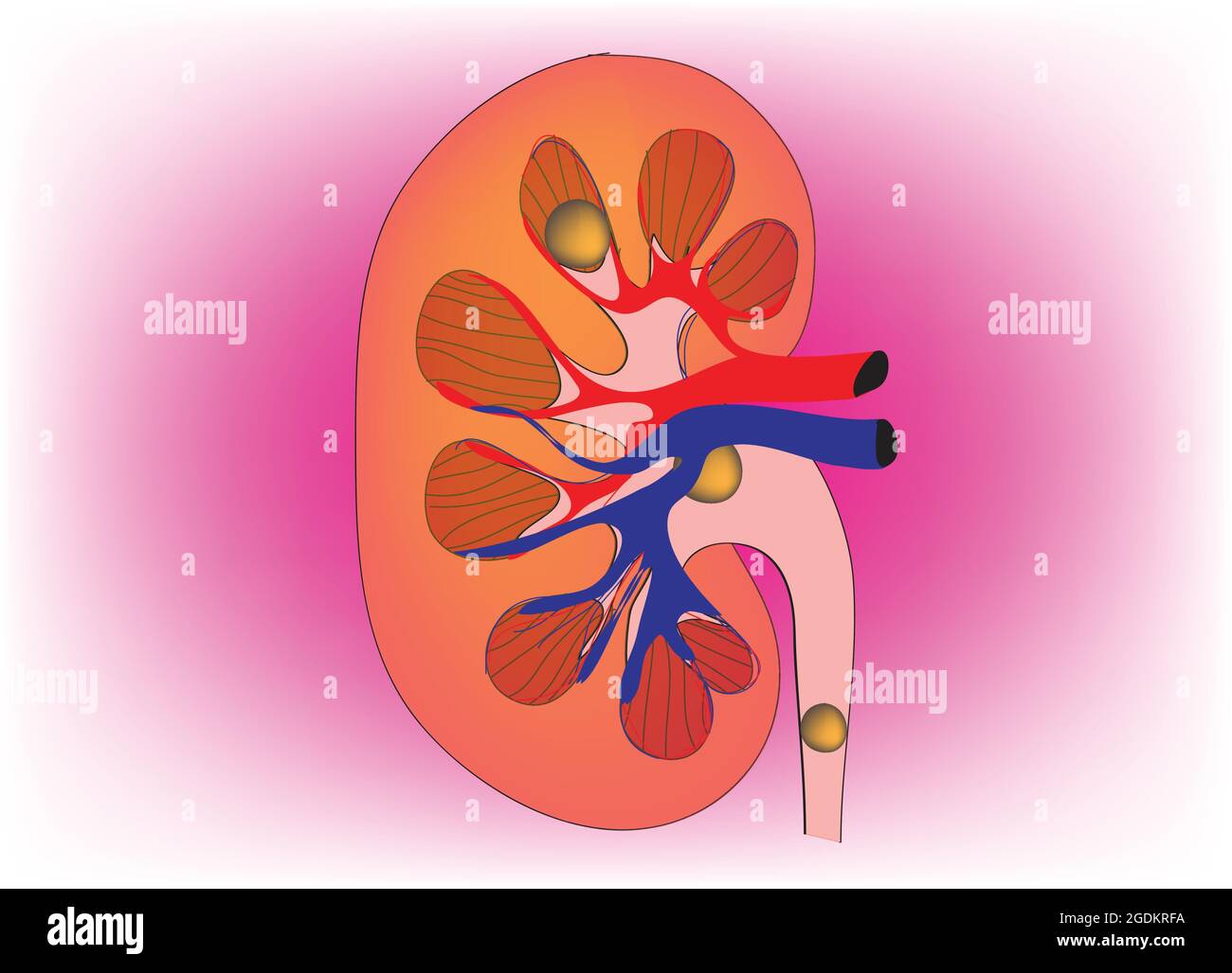 Anatomia biologica dei calcoli renali, illustrazione della pietra del rene all'interno di un rene, calcoli dolorosi della vescica, calcoli renali dolorosi, formazione della pietra del rene Illustrazione Vettoriale