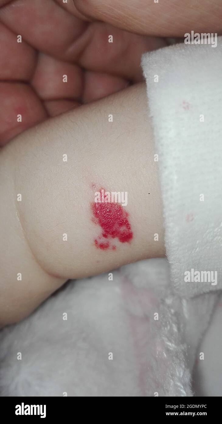 Angioma o emangioma rosa sul braccio di un bambino Foto stock - Alamy