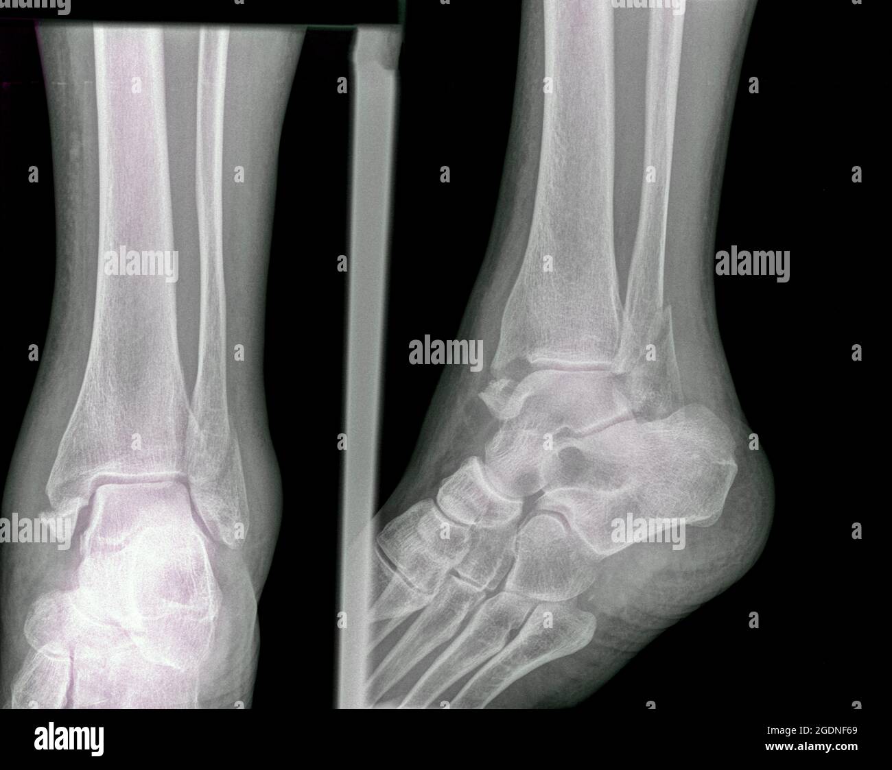 Frattura della tibia distale e della fibula. Raggi X di un maschio di 57 anni Foto Stock