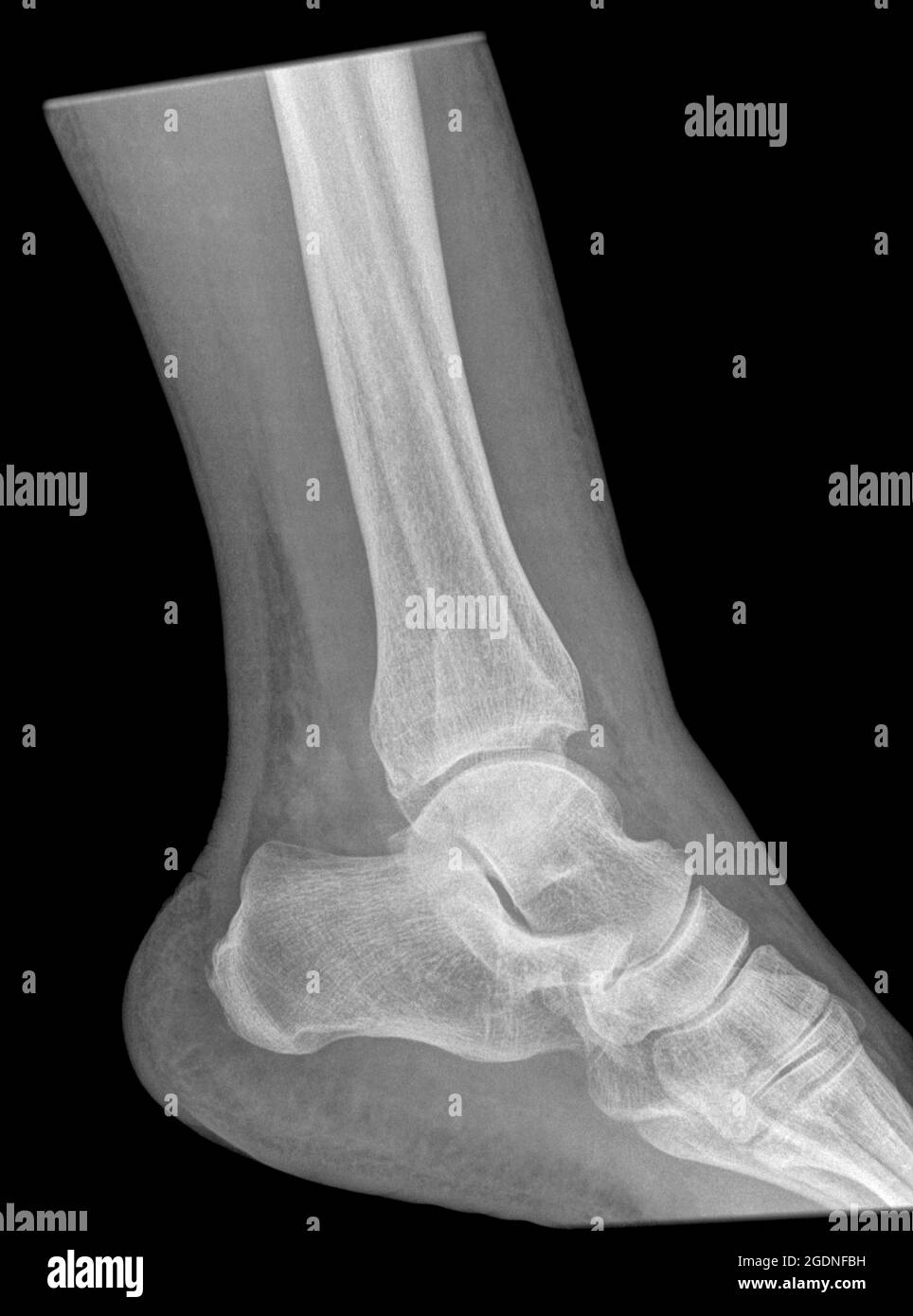 Frattura della tibia distale e della fibula. Raggi X di un maschio di 57 anni Foto Stock