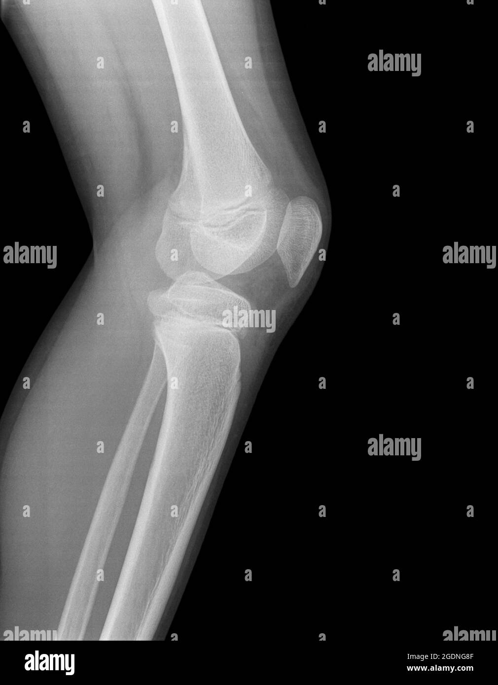 maschio di 13 anni con una contusione sul ginocchio sinistro. Vista laterale senza frattura Foto Stock